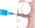 Spezielle Zahnbürste für die Zahnzwischenräume